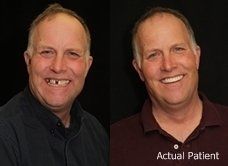 before and after dental implants