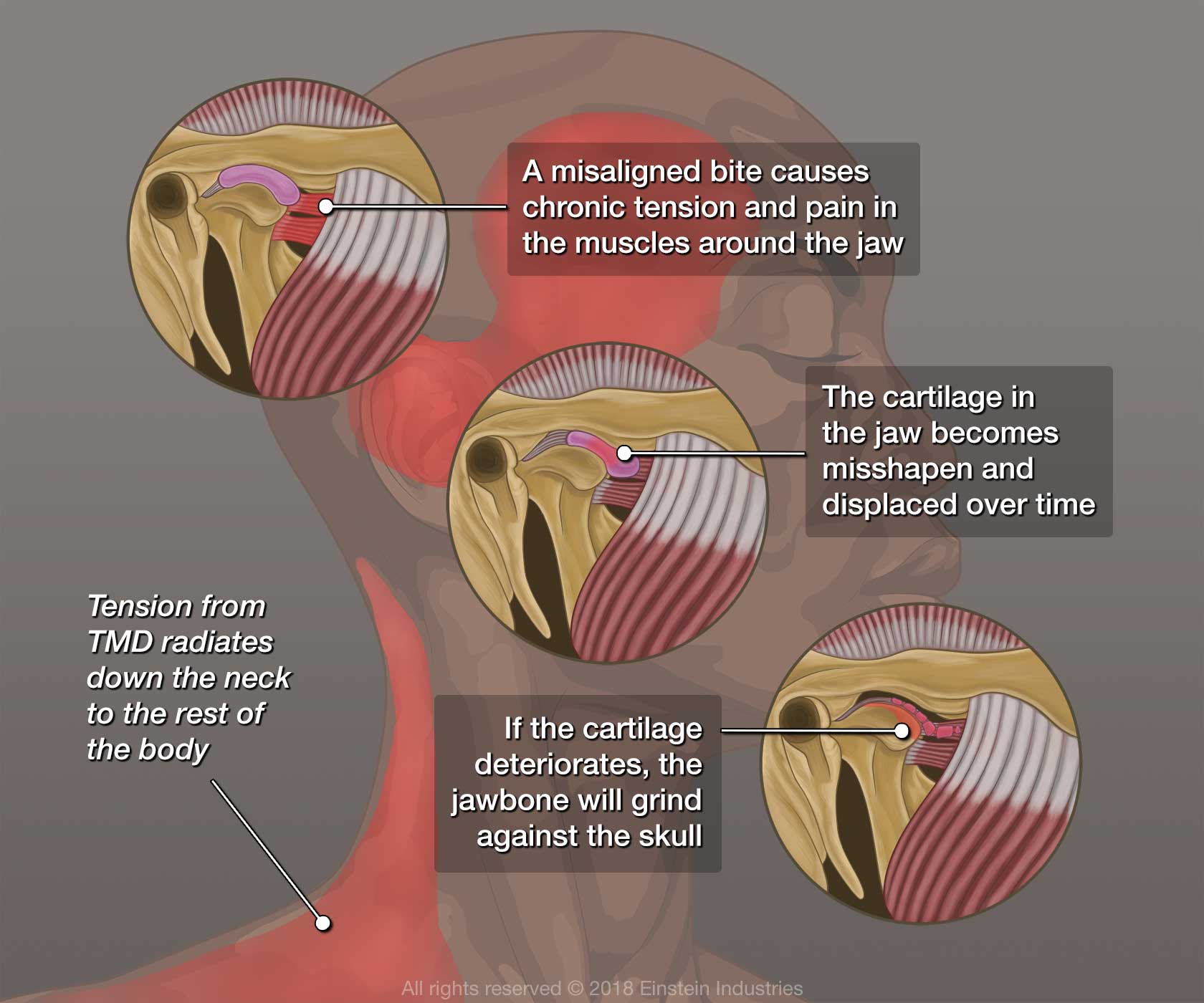 A Closer Look at TMJ Disorder